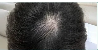 Da đầu before washing — minh hoạ lộ trình chăm sóc tại Lian