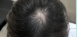 Da đầu after 10 washes — minh hoạ lộ trình chăm sóc tại Lian