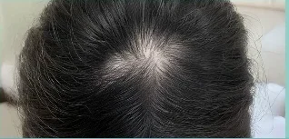 Da đầu after 20 washes — minh hoạ lộ trình chăm sóc tại Lian