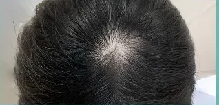 Da đầu after 30 washes — minh hoạ lộ trình chăm sóc tại Lian