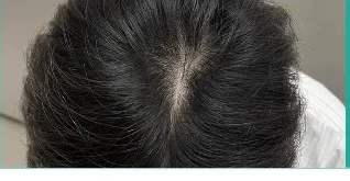 Da đầu after 50 washes — minh hoạ lộ trình chăm sóc tại Lian